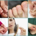 Симптоматика онемения пальцев на левой ноге