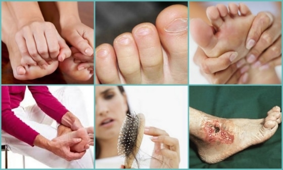 Симптоматика онемения пальцев на левой ноге