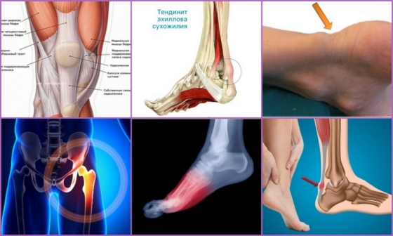 Симптоматика развития тендинита на ноге