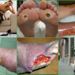 Симптомы и внешние проявления артериальной язвы на ногах