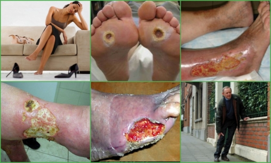 Симптомы и внешние проявления артериальной язвы на ногах