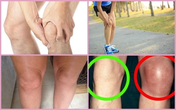 Симптомы артроза коленного сустава 