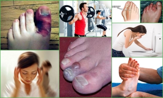 Симптомы болей суставов пальцев на ногах