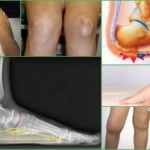Симптомы экзостоза колена, кости и стопы