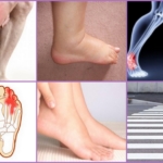 Симптомы остеохондроза на ногах
