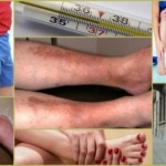Симптомы при атеросклерозе сосудов нижних конечностей