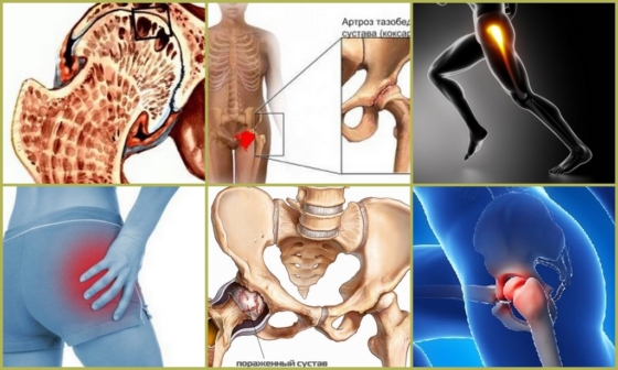 Симптомы развития артроза тазобедренного сустава