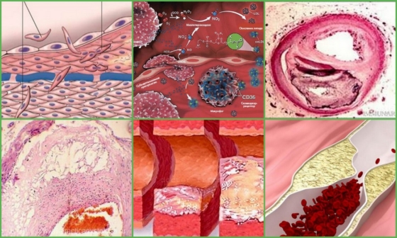 Стадии развития атеросклероза сосудов
