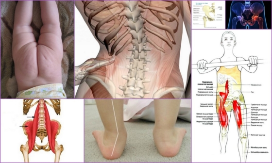 Симптомы развития патологии тазобедренного сустава