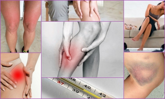 Симптомы развития тромбоза на ногах