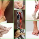 Симптомы возникновения онемения ног