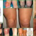 Синовит и бурсит коленного сустава – внешние характеристики