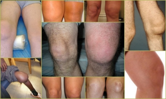 Синовит колена – внешние проявления
