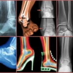 Снимки рентгена голеностопного сустава