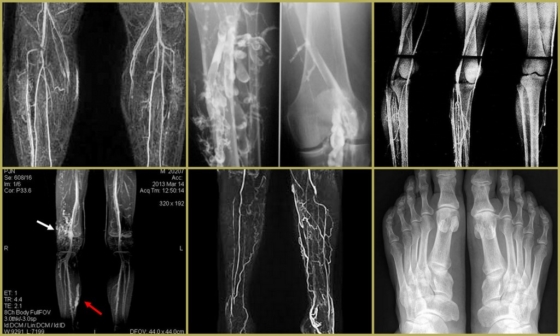 Снимки тромбофлебита нижних конечностей