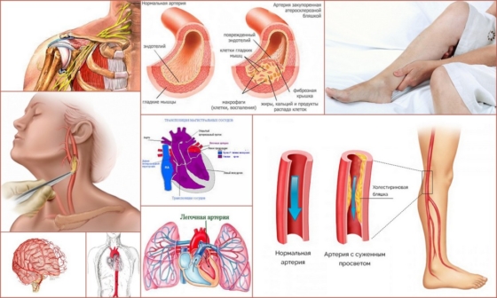 Сосуды, которые поражает нестенозирующий атеросклероз