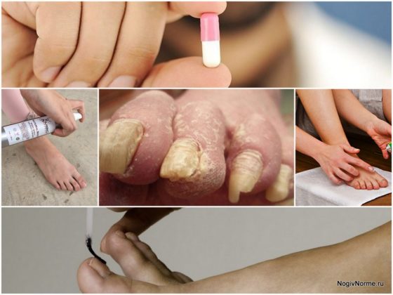 Эффективные способы лечения грибка стопы и ногтей