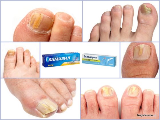 Сравнение Ламизила и Экзодерила в эффективности лечения грибка ногтей