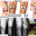 Стадии развития патологии колена