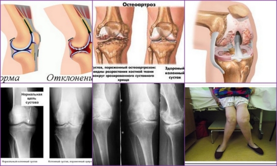 Стадии развития патологии колена