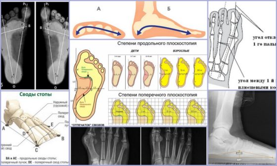 Степени поперечного и продольного плоскостопия