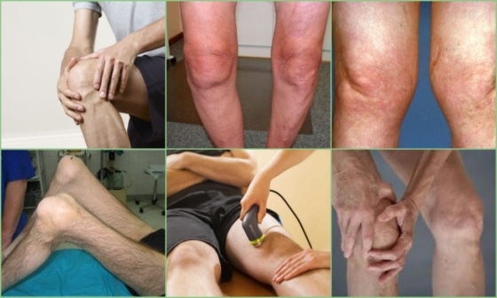 Степени поражения колена гонартрозом