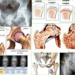 Степени развития патологии суставов