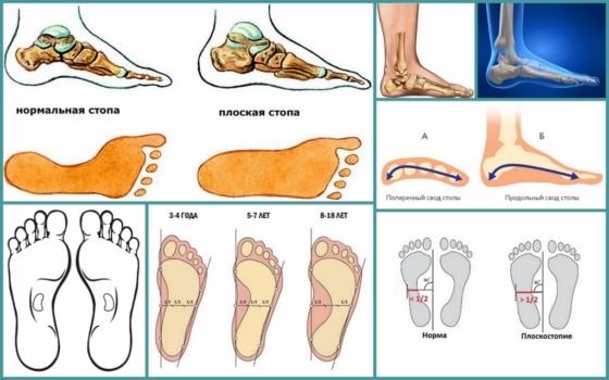 Строение здоровой стопы и при плоскостопии
