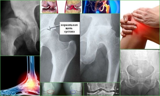 Субхондральный остеосклероз – внешние проявления