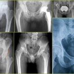 Проявление патологий тазобедренного сустава на рентгене