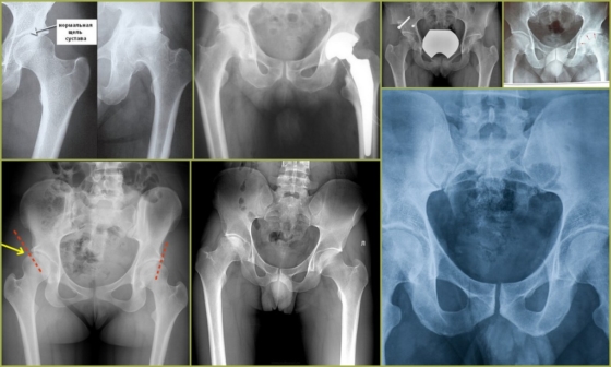 Проявление патологий тазобедренного сустава на рентгене