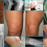 Тендинит коленного сустава – внешние проявления и рентген