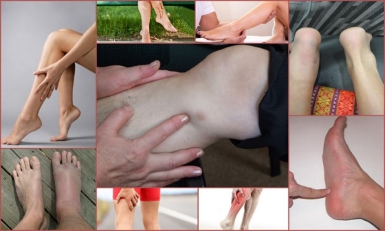 Тендинит – внешние проявления на ногах