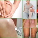 Тендиноз коленного сустава – внешние проявления