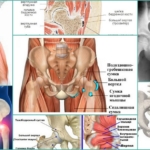 Трохантерит тазобедренного сустава – внешние проявления