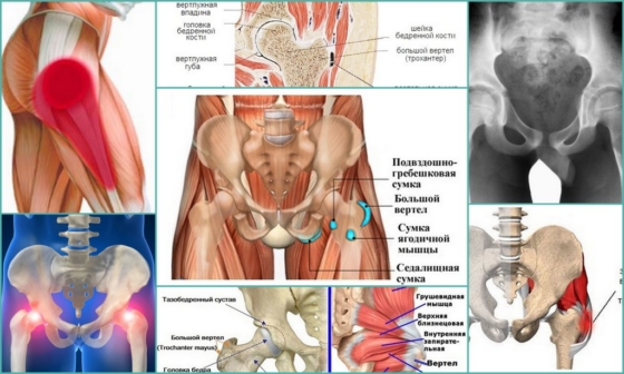 Трохантерит тазобедренного сустава – внешние проявления