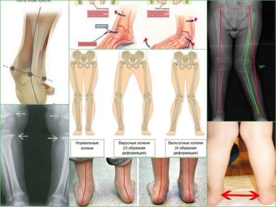 Вальгусная деформация голеней и стоп