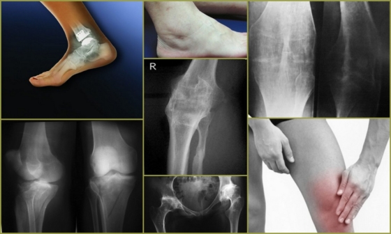 Виды анкилоза суставов на ногах