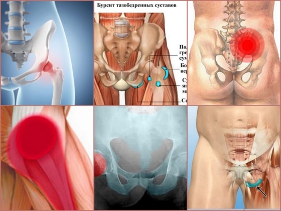 Виды бурсита тазобедренного сустава