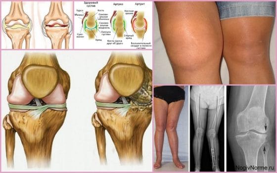 Внешние различия артрита и артроза коленного сустава