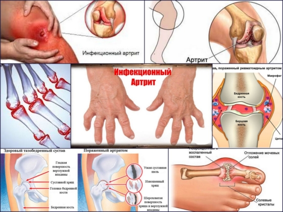 Внешний вид инфекционного артрита