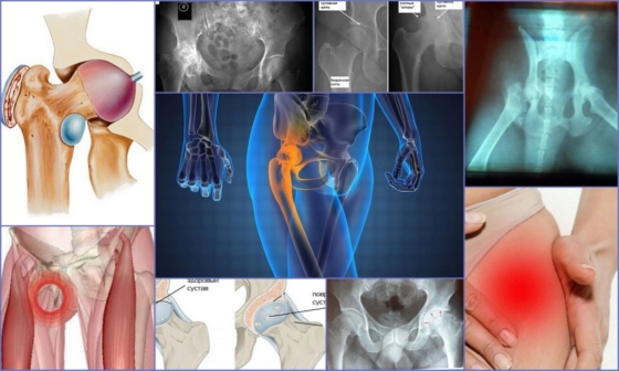 Заболевания тазобедренного сустава