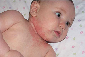 Аллергический дерматит у ребенка на шее