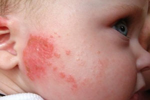 Фото дерматита на лице у ребенка