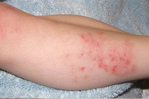 Аллергический дерматит у ребенка на руке