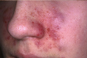 Фото дерматита на лице у взрослого человека