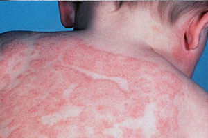 Аллергический дерматит у ребенка на спине