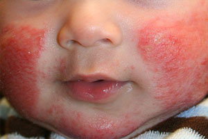 Аллергический дерматит у ребенка на лице, щеках
