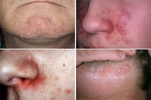 Фото дерматита на лице у людей