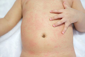 Аллергический дерматит у ребенка на теле